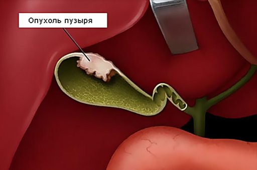 Где лучше всего лечить рак желчного пузыря?