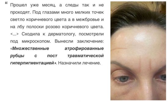 Омоложение при помощи плазмолифта – мнение эксперта