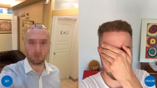 FUE – инновационный метод восстановления волос