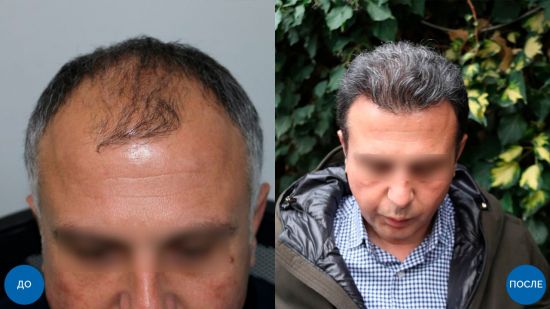 FUE – инновационный метод восстановления волос