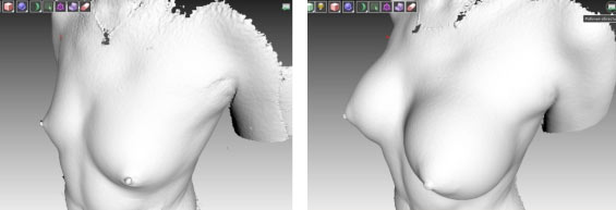 Результаты липофилинга груди в 3D-изображении