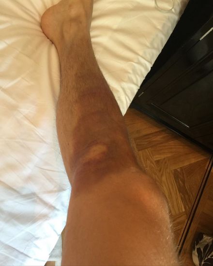 Сергей Лазарев сильно повредил ногу